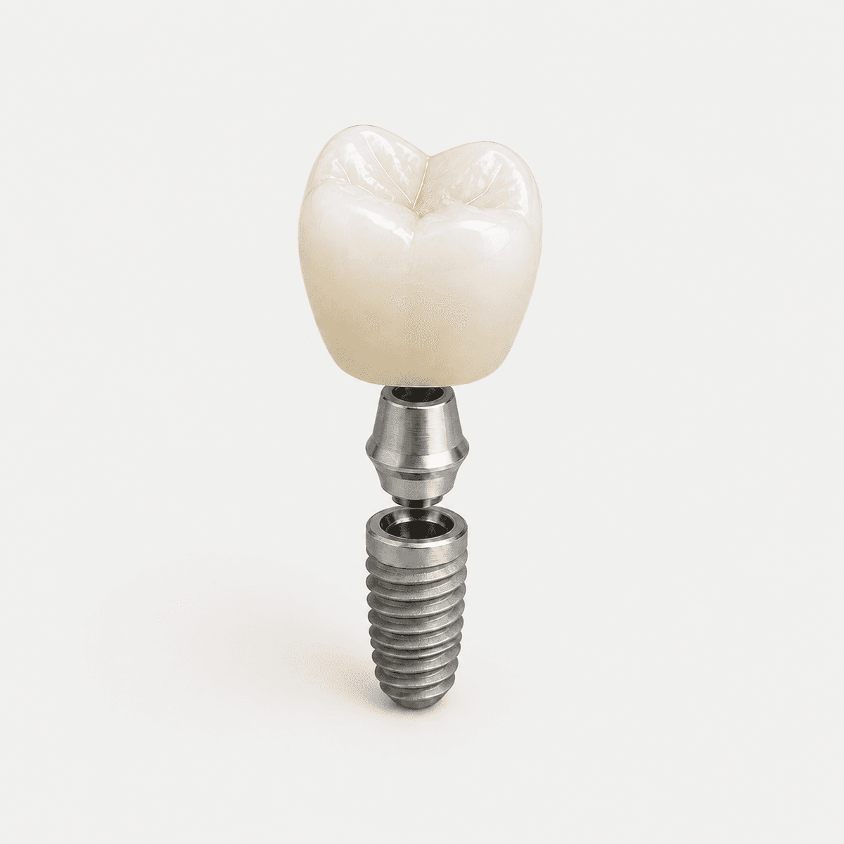 Implant Restoration dental restoration