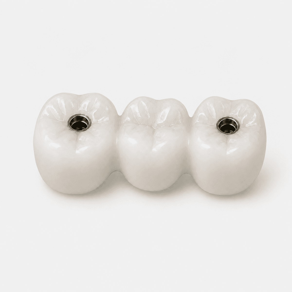 Screw-Retained PMMA Bridge