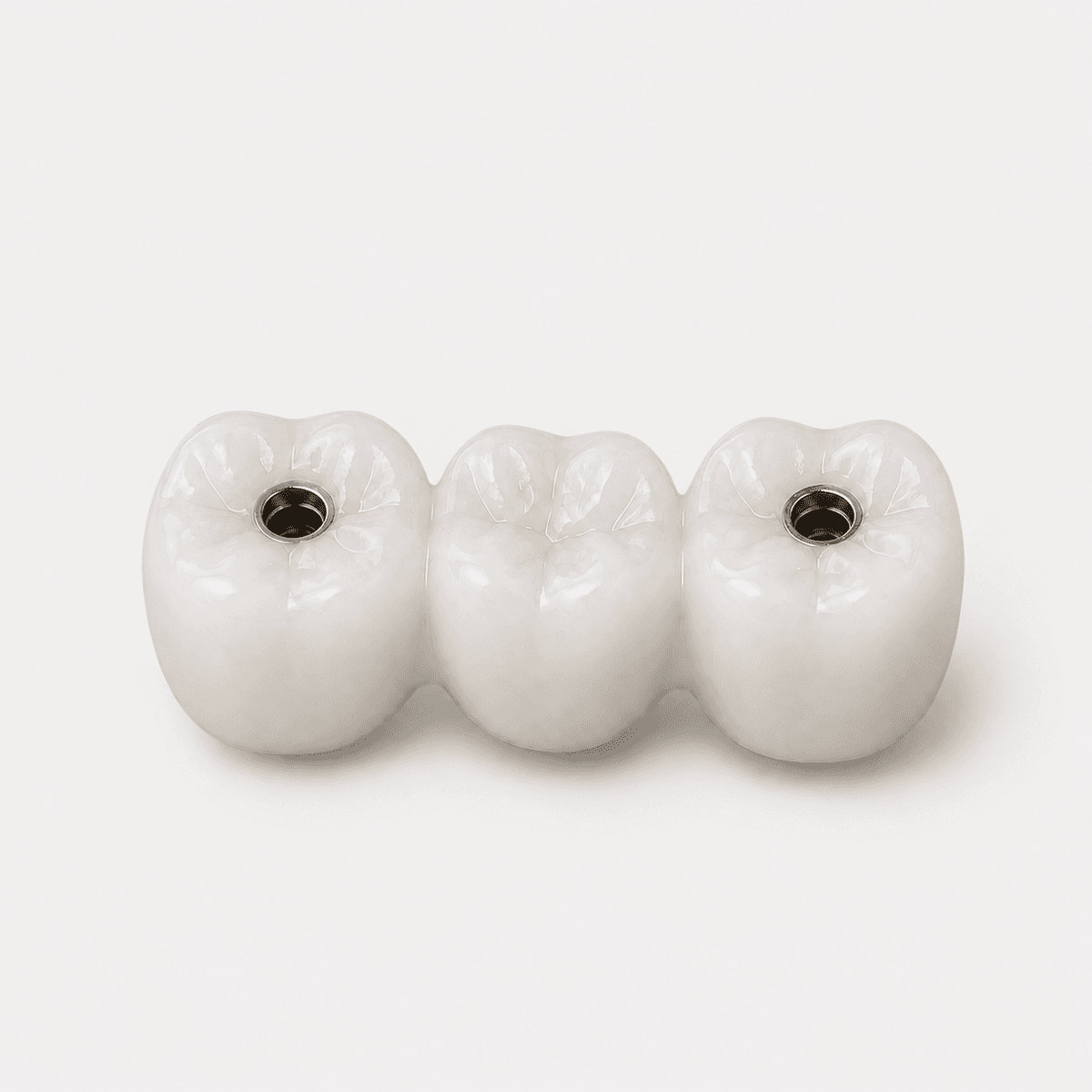 Screw-Retained Zirconia Bridge